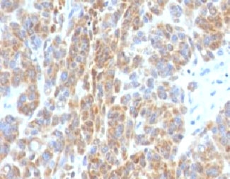 BCL2 / Bcl-2 Antibody - Formalin-fixed, paraffin-embedded human melanoma stained with Bcl2 antibody (BCL2/782).  This image was taken for the unmodified form of this product. Other forms have not been tested.