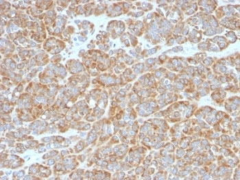 BCL2 / Bcl-2 Antibody - Formalin-fixed, paraffin-embedded human melanoma stained with Bcl-2 antibody (BCL2/796).  This image was taken for the unmodified form of this product. Other forms have not been tested.