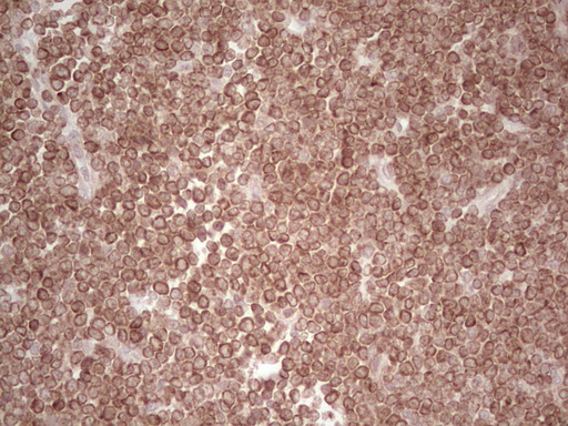 BCL2 / Bcl-2 Antibody - Immunohistochemical staining of paraffin-embedded Human lymphoma tissue using anti-BCL2 mouse monoclonal antibody. (Heat-induced epitope retrieval by 1 mM EDTA in 10mM Tris, pH8.5, 120C for 3min,
