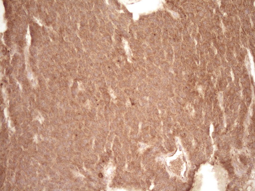 BCL2 / Bcl-2 Antibody - Immunohistochemical staining of paraffin-embedded Carcinoma of Human lung tissue using anti-BCL2 mouse monoclonal antibody. (Heat-induced epitope retrieval by 1 mM EDTA in 10mM Tris, pH8.5, 120C for 3min,