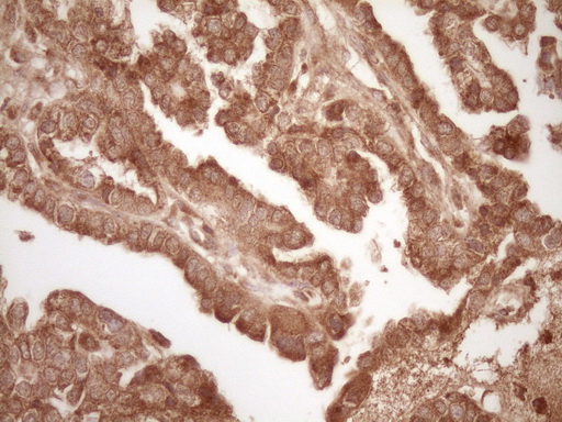 BCL2 / Bcl-2 Antibody - Immunohistochemical staining of paraffin-embedded Adenocarcinoma of Human ovary tissue using anti-BCL2 mouse monoclonal antibody. (Heat-induced epitope retrieval by 1 mM EDTA in 10mM Tris, pH8.5, 120C for 3min,