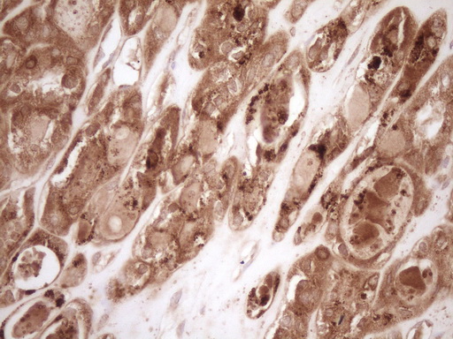 BCL2 / Bcl-2 Antibody - Immunohistochemical staining of paraffin-embedded Carcinoma of Human thyroid tissue using anti-BCL2 mouse monoclonal antibody. (Heat-induced epitope retrieval by 1 mM EDTA in 10mM Tris, pH8.5, 120C for 3min,