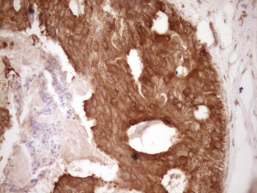 BCL2 / Bcl-2 Antibody - Immunohistochemical staining of paraffin-embedded Adenocarcinoma of Human breast tissue using anti-BCL2 mouse monoclonal antibody. (Heat-induced epitope retrieval by 1 mM EDTA in 10mM Tris, pH8.5, 120C for 3min,