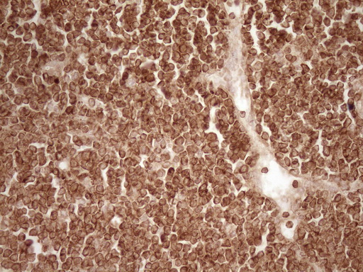 BCL2 / Bcl-2 Antibody - Immunohistochemical staining of paraffin-embedded Human lymphoma tissue using anti-BCL2 mouse monoclonal antibody. (Heat-induced epitope retrieval by 1 mM EDTA in 10mM Tris, pH8.5, 120C for 3min,