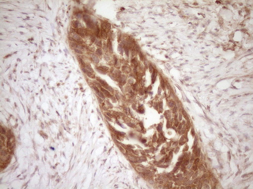 BCL2 / Bcl-2 Antibody - Immunohistochemical staining of paraffin-embedded Carcinoma of Human kidney tissue using anti-BCL2 mouse monoclonal antibody. (Heat-induced epitope retrieval by 1 mM EDTA in 10mM Tris, pH8.5, 120C for 3min,