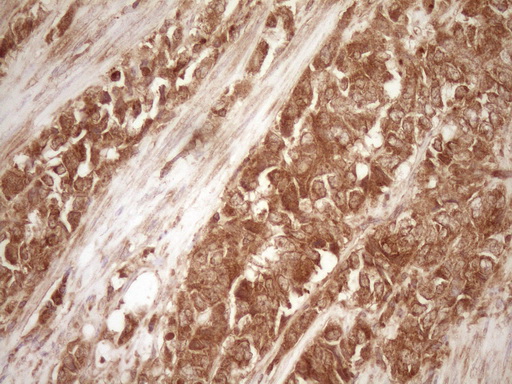 BCL2 / Bcl-2 Antibody - IHC of paraffin-embedded Adenocarcinoma of Human endometrium tissue using anti-BCL2 mouse monoclonal antibody. (Heat-induced epitope retrieval by 1 mM EDTA in 10mM Tris, pH8.5, 120°C for 3min).