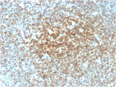 BCL2 / Bcl-2 Antibody - Formalin-paraffin human Follicular Lymphoma stained with Bcl-2 Mouse Recombinant Monoclonal Antibody (rBCL2/782).