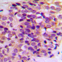 BCL2 / Bcl-2 Antibody - Immunohistochemical analysis of BCL2 staining in human breast cancer formalin fixed paraffin embedded tissue section. The section was pre-treated using heat mediated antigen retrieval with sodium citrate buffer (pH 6.0). The section was then incubated with the antibody at room temperature and detected using an HRP conjugated compact polymer system. DAB was used as the chromogen. The section was then counterstained with hematoxylin and mounted with DPX. w