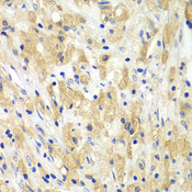 BCL2 / Bcl-2 Antibody - Immunohistochemistry of paraffin-embedded human lung cancer tissue.