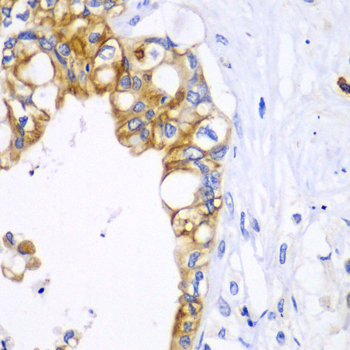 BCL2 / Bcl-2 Antibody - Immunohistochemistry of paraffin-embedded human liver cancer using BCL2 antibodyat dilution of 1:100 (40x lens).