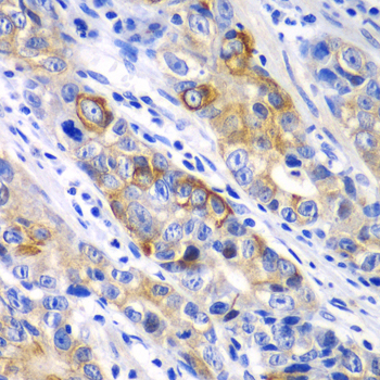BCL2 / Bcl-2 Antibody - Immunohistochemistry of paraffin-embedded human gastric cancer using BCL2 antibodyat dilution of 1:100 (40x lens).