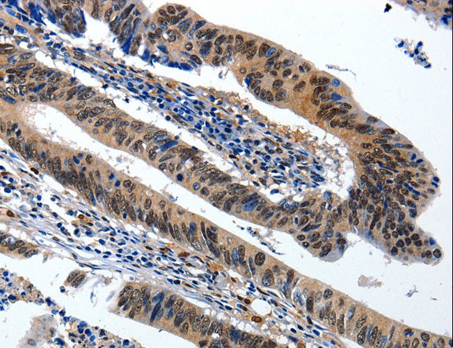BCL2 / Bcl-2 Antibody - Immunohistochemistry of paraffin-embedded Human colorectal cancer using BCL2 Polyclonal Antibody at dilution of 1:20.