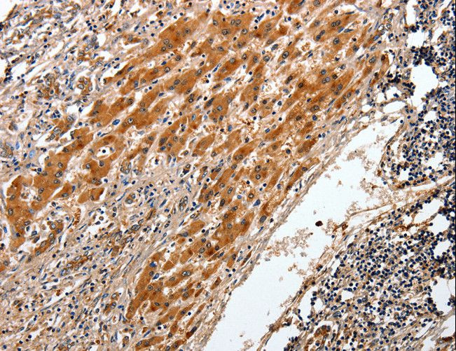 BCL2 / Bcl-2 Antibody - Immunohistochemistry of paraffin-embedded Human liver cancer using BCL2 Polyclonal Antibody at dilution of 1:20.