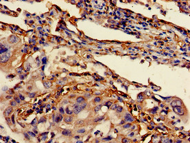BCL2 / Bcl-2 Antibody - Immunohistochemistry of paraffin-embedded human lung cancer using BCL2 Antibody at dilution of 1:100