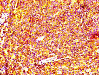 BCL2 / Bcl-2 Antibody - Immunohistochemistry Dilution at 1:100 and staining in paraffin-embedded human lymph node tissue performed on a Leica BondTM system. After dewaxing and hydration, antigen retrieval was mediated by high pressure in a citrate buffer (pH 6.0). Section was blocked with 10% normal Goat serum 30min at RT. Then primary antibody (1% BSA) was incubated at 4°C overnight. The primary is detected by a biotinylated Secondary antibody and visualized using an HRP conjugated SP system.