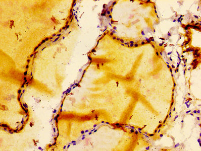 BCL2 / Bcl-2 Antibody - Immunohistochemistry Dilution at 1:100 and staining in paraffin-embedded human thyroid tissue performed on a Leica BondTM system. After dewaxing and hydration, antigen retrieval was mediated by high pressure in a citrate buffer (pH 6.0). Section was blocked with 10% normal Goat serum 30min at RT. Then primary antibody (1% BSA) was incubated at 4°C overnight. The primary is detected by a biotinylated Secondary antibody and visualized using an HRP conjugated SP system.