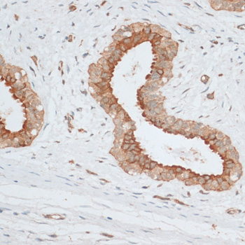 BCL2 / Bcl-2 Antibody - Immunohistochemistry of paraffin-embedded human breast cancer using BCL2 antibody at dilution of 1:100 (40x lens).