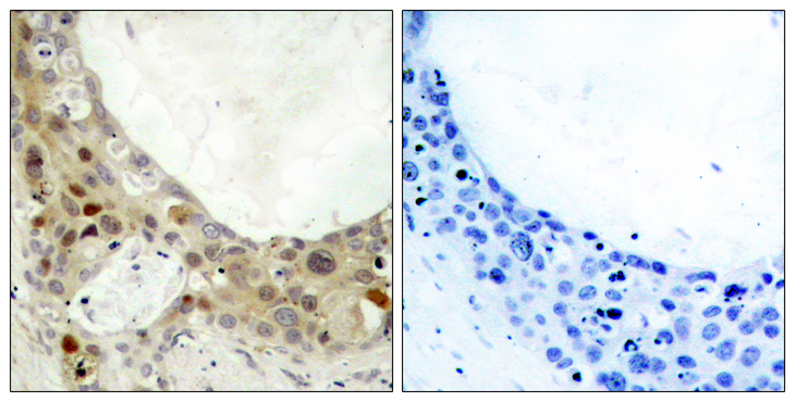 BCL2 / Bcl-2 Antibody - Immunohistochemistry analysis of paraffin-embedded human breast carcinoma, using BCL-2 (Phospho-Ser70) Antibody. The picture on the right is blocked with the phospho peptide.