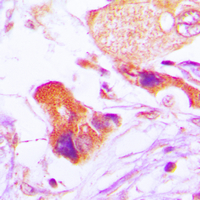 BCL2 / Bcl-2 Antibody - Immunohistochemical analysis of BCL2 (pS70) staining in human lung cancer formalin fixed paraffin embedded tissue section. The section was pre-treated using heat mediated antigen retrieval with sodium citrate buffer (pH 6.0). The section was then incubated with the antibody at room temperature and detected using an HRP conjugated compact polymer system. DAB was used as the chromogen. The section was then counterstained with hematoxylin and mounted with DPX.