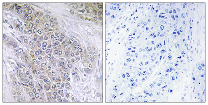 BCL2 / Bcl-2 Antibody - Immunohistochemistry analysis of paraffin-embedded human breast carcinoma, using BCL-2 (Phospho-Thr56) Antibody. The picture on the right is blocked with the phospho peptide.