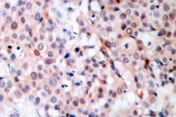 BCL2 / Bcl-2 Antibody - IHC of p-BCL-2 (T56) pAb in paraffin-embedded human breast carcinoma tissue.