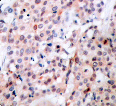BCL2 / Bcl-2 Antibody - Immunohistochemical analysis of paraffin-embedded human breast carcinoma tissue.