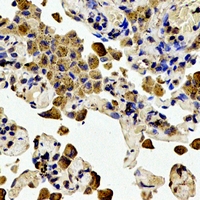 BCL2 / Bcl-2 Antibody - Immunohistochemical analysis of BCL2 (pT56) staining in human lung cancer formalin fixed paraffin embedded tissue section. The section was pre-treated using heat mediated antigen retrieval with sodium citrate buffer (pH 6.0). The section was then incubated with the antibody at room temperature and detected using an HRP polymer system. DAB was used as the chromogen. The section was then counterstained with hematoxylin and mounted with DPX.