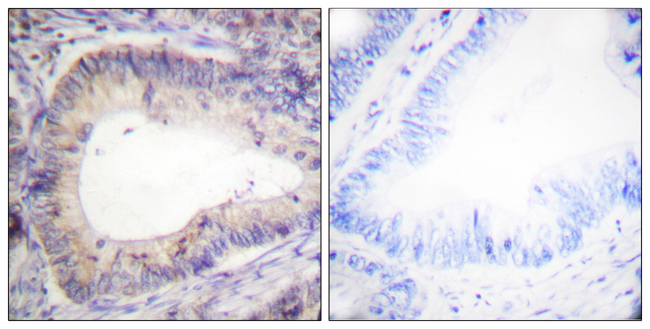 BCL2 / Bcl-2 Antibody - Immunohistochemistry analysis of paraffin-embedded human colon carcinoma, using BCL-2 (Phospho-Thr69) Antibody. The picture on the right is blocked with the phospho peptide.