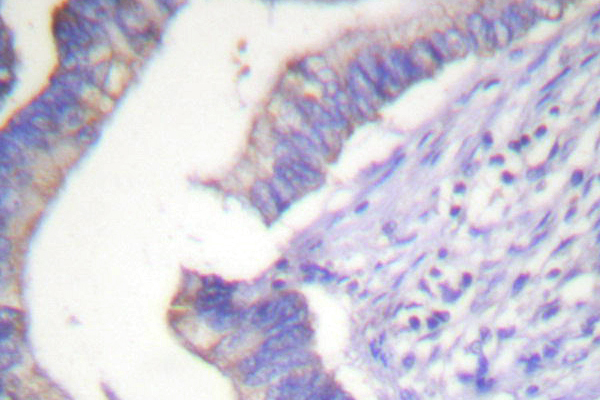 BCL2 / Bcl-2 Antibody - IHC of BCL-2 (P65) pAb in paraffin-embedded human colon carcinoma tissue.