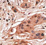 BCL2A1 Antibody - Formalin-fixed and paraffin-embedded human cancer tissue reacted with the primary antibody, which was peroxidase-conjugated to the secondary antibody, followed by DAB staining. This data demonstrates the use of this antibody for immunohistochemistry; clinical relevance has not been evaluated. BC = breast carcinoma; HC = hepatocarcinoma.