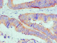 BCL2L1 / BCL-XL Antibody - Immunohistochemical of paraffin-embedded Human Colon cancer tissue using BCL2L1 Monoclonal Antibody at dilution of 1:200