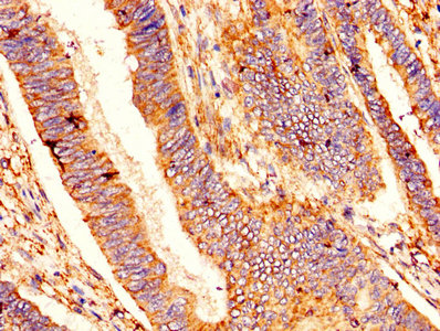 BCL2L1 / BCL-XL Antibody - IHC image of BCL2L1 Antibody diluted at 1:400 and staining in paraffin-embedded human colon cancer performed on a Leica BondTM system. After dewaxing and hydration, antigen retrieval was mediated by high pressure in a citrate buffer (pH 6.0). Section was blocked with 10% normal goat serum 30min at RT. Then primary antibody (1% BSA) was incubated at 4°C overnight. The primary is detected by a biotinylated secondary antibody and visualized using an HRP conjugated SP system.