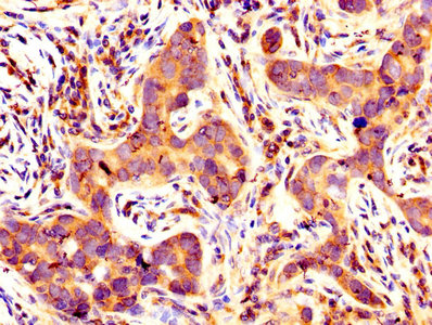 BCL2L1 / BCL-XL Antibody - IHC image of BCL2L1 Antibody diluted at 1:400 and staining in paraffin-embedded human pancreatic cancer performed on a Leica BondTM system. After dewaxing and hydration, antigen retrieval was mediated by high pressure in a citrate buffer (pH 6.0). Section was blocked with 10% normal goat serum 30min at RT. Then primary antibody (1% BSA) was incubated at 4°C overnight. The primary is detected by a biotinylated secondary antibody and visualized using an HRP conjugated SP system.