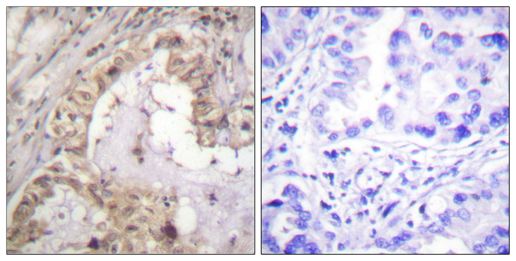 BCL2L1 / BCL-XL Antibody - Immunohistochemistry analysis of paraffin-embedded human lung carcinoma tissue, using BCL-XL Antibody. The picture on the right is blocked with the synthesized peptide.