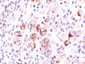BCL2L1 / BCL-XL Antibody - Formalin-fixed, paraffin-embedded human Hodgkin's lymphoma stained with Bcl-x antibody (2H12). Note cytoplasmic and membrane staining.  This image was taken for the unmodified form of this product. Other forms have not been tested.