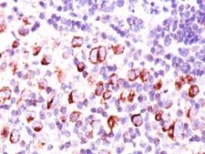 BCL2L1 / BCL-XL Antibody - Formalin-paraffin Hodgkin's lymphoma stained with Bcl-x antibody (BX006 + 2H12).  This image was taken for the unmodified form of this product. Other forms have not been tested.