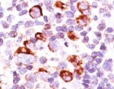 BCL2L1 / BCL-XL Antibody - Formalin-fixed, paraffin-embedded human Hodgkin's lymphoma stained with anti-Bcl-X antibody (SPM165).  This image was taken for the unmodified form of this product. Other forms have not been tested.