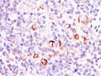 BCL2L1 / BCL-XL Antibody - Formalin-fixed, paraffin-embedded human Hodgkin's lymphoma stained with Bcl-X antibody (SPM337).  This image was taken for the unmodified form of this product. Other forms have not been tested.