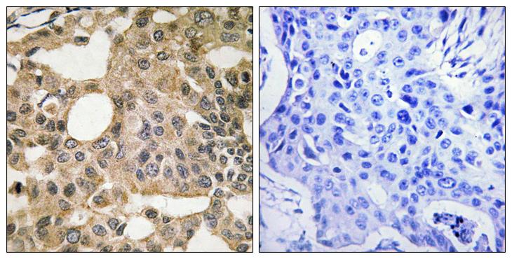 BCL2L1 / BCL-XL Antibody - Immunohistochemistry analysis of paraffin-embedded human breast carcinoma tissue, using BCL-XL Antibody. The picture on the right is blocked with the synthesized peptide.