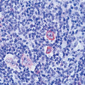 BCL2L1 / BCL-XL Antibody - Formalin-fixed, paraffin-embedded human Hodgkin's lymphoma stained with peroxidase-conjugate and AEC chromogen. Note cytoplasmic staining of Hodgkin's cells.  This image was taken for the unmodified form of this product. Other forms have not been tested.