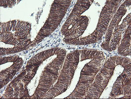 BCL2L1 / BCL-XL Antibody - IHC of paraffin-embedded Adenocarcinoma of Human endometrium tissue using anti-BCL2L1 mouse monoclonal antibody.