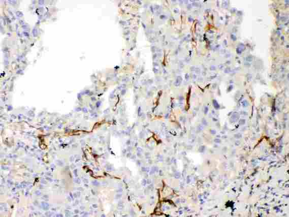 BCL2L1 / BCL-XL Antibody - Bcl-XL was detected in paraffin-embedded sections of human lung cancer tissues using rabbit anti- Bcl-XL Antigen Affinity purified polyclonal antibody