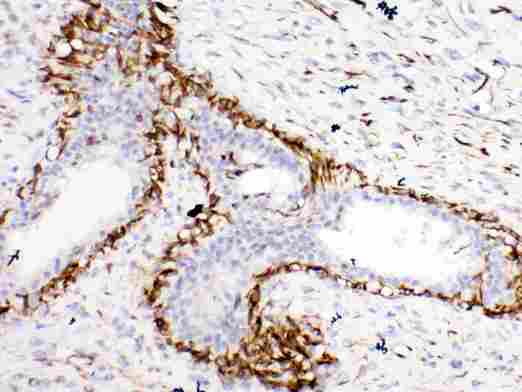 BCL2L1 / BCL-XL Antibody - Bcl-XL was detected in paraffin-embedded sections of human mammary cancer tissues using rabbit anti- Bcl-XL Antigen Affinity purified polyclonal antibody