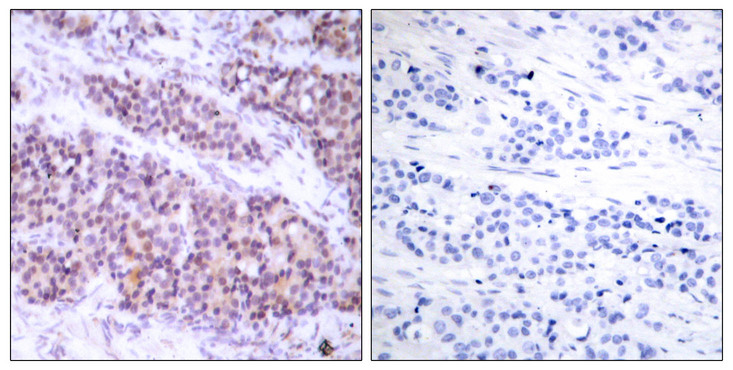 BCL2L1 / BCL-XL Antibody - Immunohistochemistry analysis of paraffin-embedded human breast carcinoma, using BCL-XL (Phospho-Ser62) Antibody. The picture on the right is blocked with the phospho peptide.