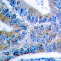 BCL2L1 / BCL-XL Antibody - Immunohistochemical analysis of BCLX (pS62) staining in human colon cancer formalin fixed paraffin embedded tissue section. The section was pre-treated using heat mediated antigen retrieval with sodium citrate buffer (pH 6.0). The section was then incubated with the antibody at room temperature and detected using an HRP conjugated compact polymer system. DAB was used as the chromogen. The section was then counterstained with hematoxylin and mounted with DPX. w