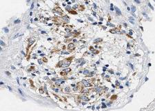 BCL2L1 / BCL-XL Antibody - 1:100 staining human lung carcinoma tissue by IHC-P. The tissue was formaldehyde fixed and a heat mediated antigen retrieval step in citrate buffer was performed. The tissue was then blocked and incubated with the antibody for 1.5 hours at 22°C. An HRP conjugated goat anti-rabbit antibody was used as the secondary.