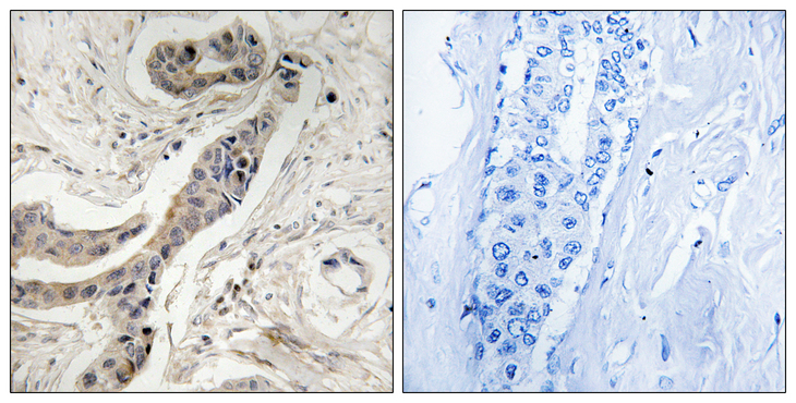 BCL2L1 / BCL-XL Antibody - Immunohistochemistry analysis of paraffin-embedded human breast carcinoma, using BCL-XL (Phospho-Thr115) Antibody. The picture on the right is blocked with the phospho peptide.