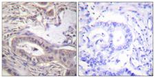 BCL2L1 / BCL-XL Antibody - Immunohistochemistry analysis of paraffin-embedded human lung carcinoma, using BCL-XL (Phospho-Thr47) Antibody. The picture on the right is blocked with the phospho peptide.