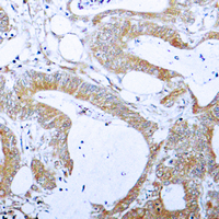 BCL2L1 / BCL-XL Antibody - Immunohistochemical analysis of BCLX (pT47) staining in human colon cancer formalin fixed paraffin embedded tissue section. The section was pre-treated using heat mediated antigen retrieval with sodium citrate buffer (pH 6.0). The section was then incubated with the antibody at room temperature and detected using an HRP-conjugated compact polymer system. DAB was used as the chromogen. The section was then counterstained with hematoxylin and mounted with DPX.