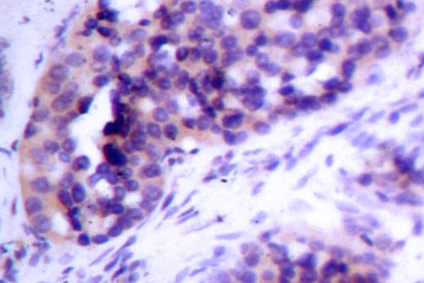BCL2L1 / BCL-XL Antibody - IHC of Bcl-X (S56) pAb in paraffin-embedded human breast tissue.